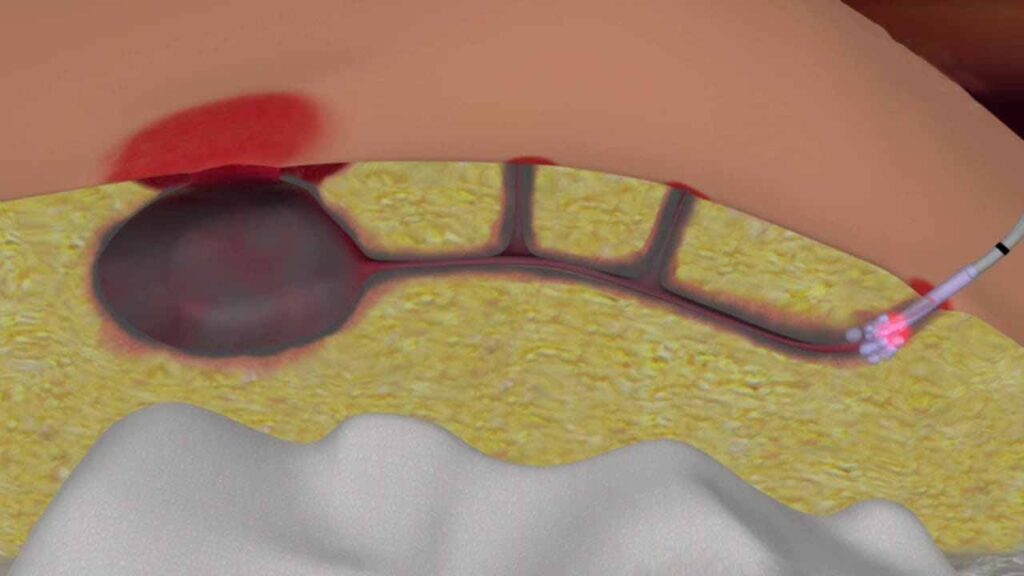 Pilonidal sinus treatment in Kolkata